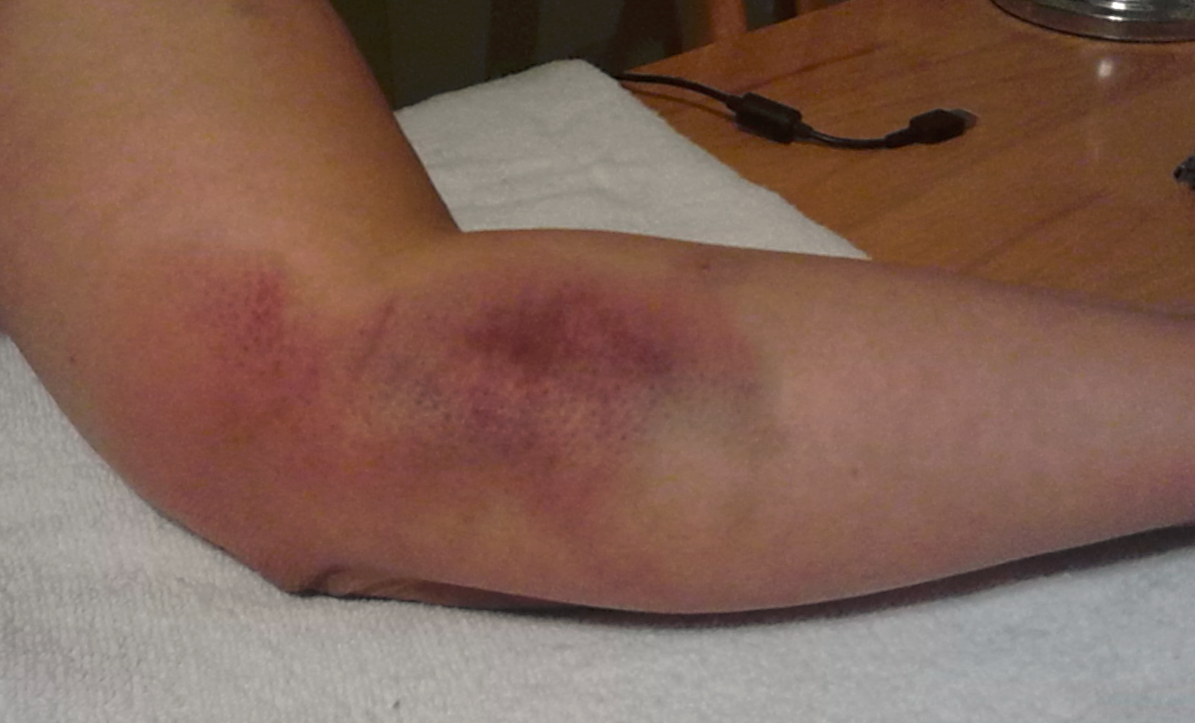 Photograph of Complainaint’s left arm